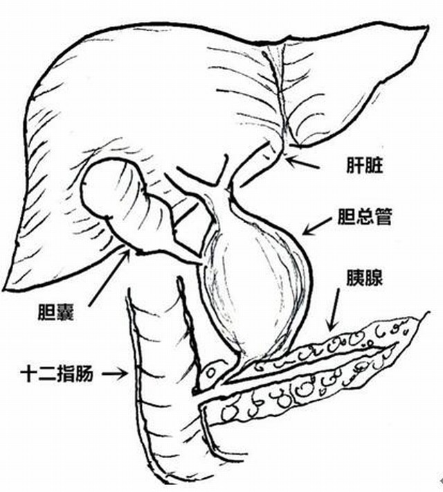 小切口治大病 经脐单孔腹腔镜微创治疗先天性胆总管囊肿